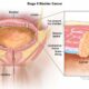 muscle invasive bladder cancer 1 80x80